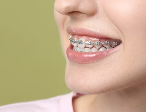 Can Braces Change Your Face Shape?