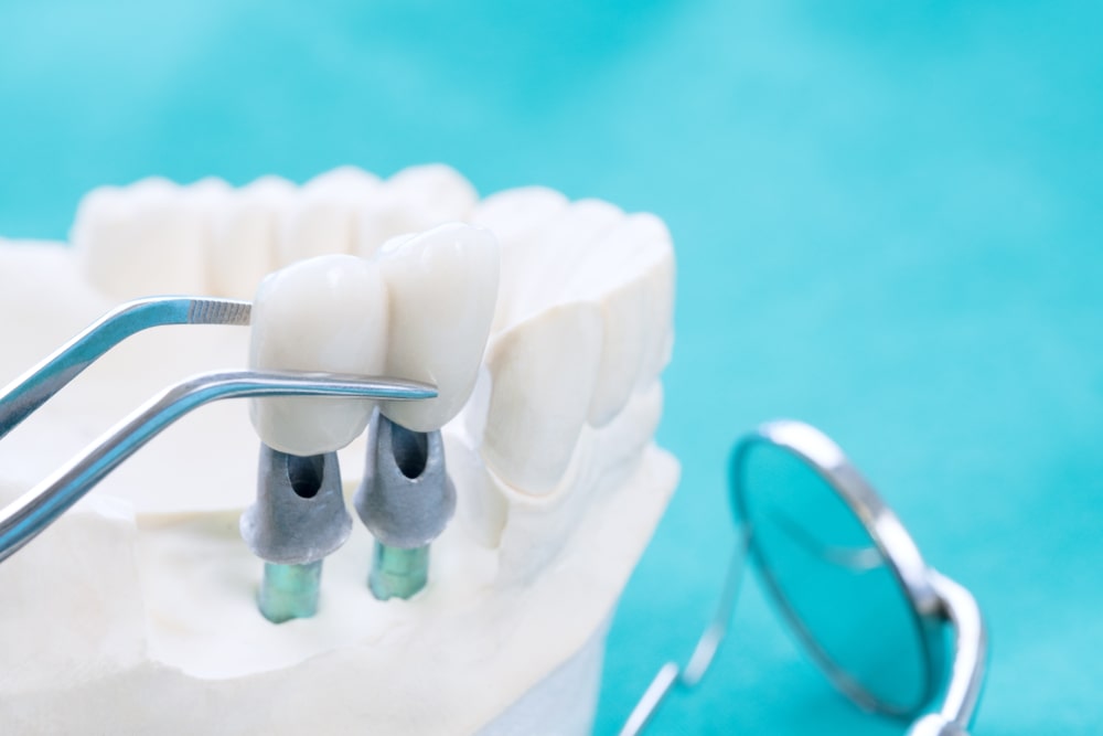 Dental implants Airdrie