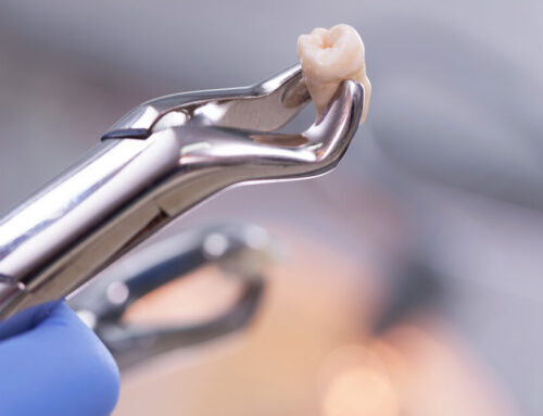 When To Consider Wisdom Teeth Removal