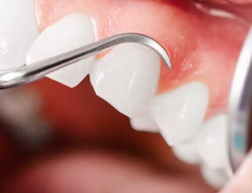 Keep Your Teeth and Gums Healthy with General Dentistry Services in Airdrie