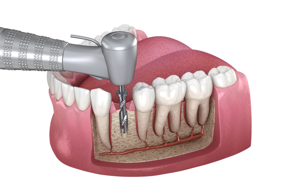 Root Canal Treatment in Airdrie