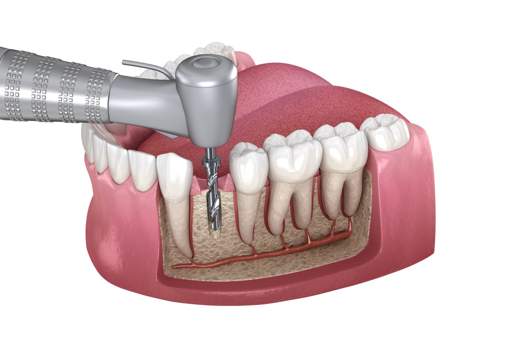 https://cdn.yankeevalleydental.ca/wp-content/uploads/2022/07/Root-Canal-Treatment-in-Airdrie.jpg