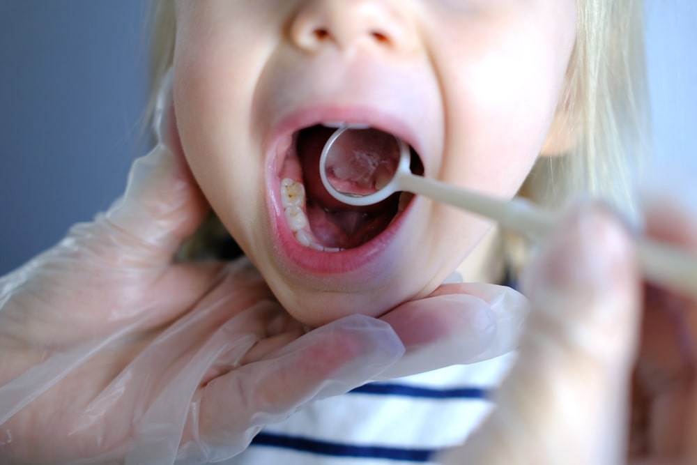 Cavities on Baby Teeth