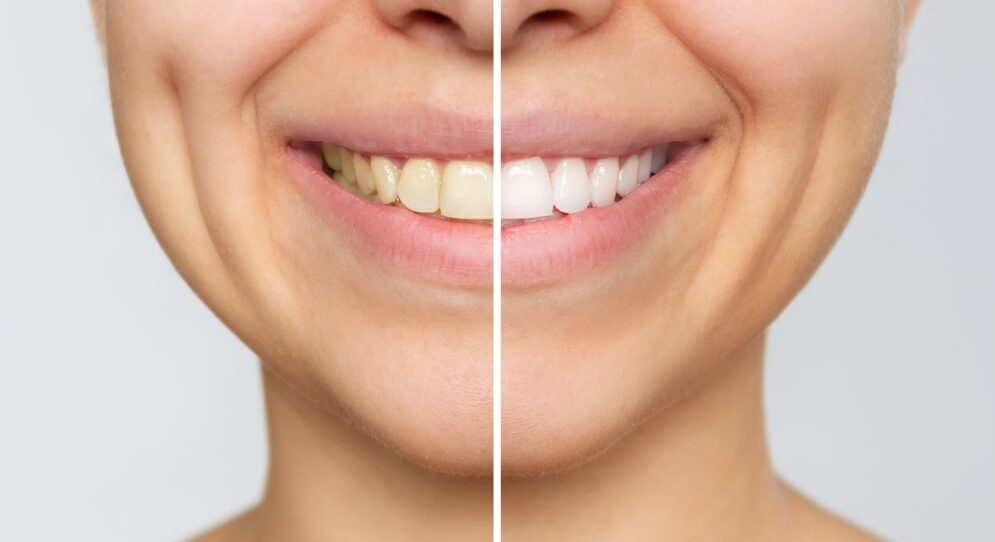 Teeth Whitening Can Transform Your Smile